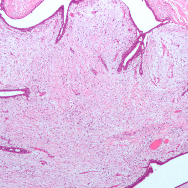 Tumeurs phyllodes du sein Diagnostic radiologique, histologique et traitement