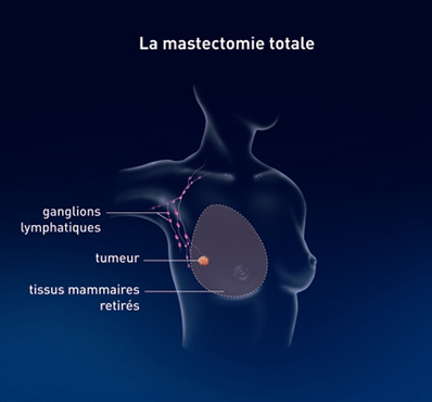 La mastectomie totale