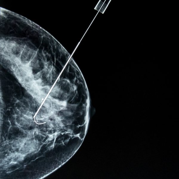 La biopsie mammaire – Modalité & intérêt dans le diagnostic du cancer du sein