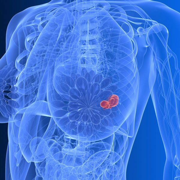 Les performances de la mammographie 3D pour diagnostiquer le cancer de sein