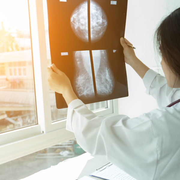Cancer du sein métastatique : quelle approche thérapeutique ?