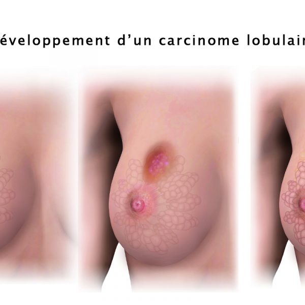 Le carcinome lobulaire in situ et infiltrant (cancer du sein lobulaire)