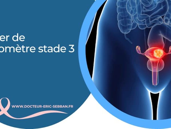 Cancer de l’utérus stade 3 : symptômes et espérance de vie