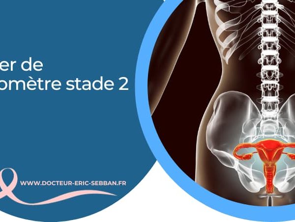 Cancer de l’utérus stade 2 : symptômes, diagnostic, traitements et espérance de vie
