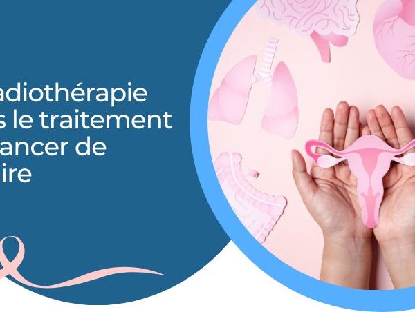 La radiothérapie dans le traitement du cancer de l’ovaire