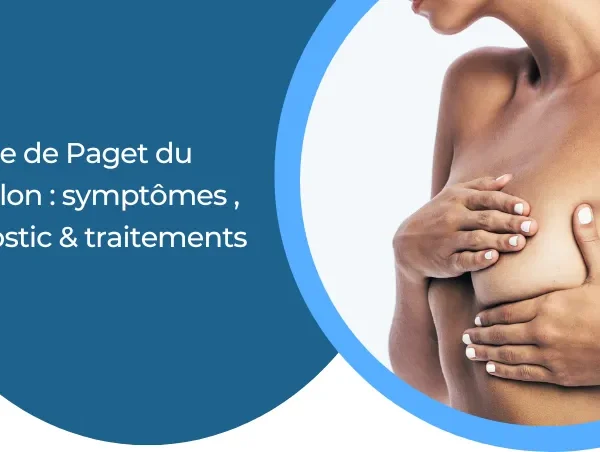 La Maladie de Paget au sein : une forme rare de cancer du sein
