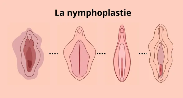hypertrophie des petites lèvres avant après nymphoplastie avant après