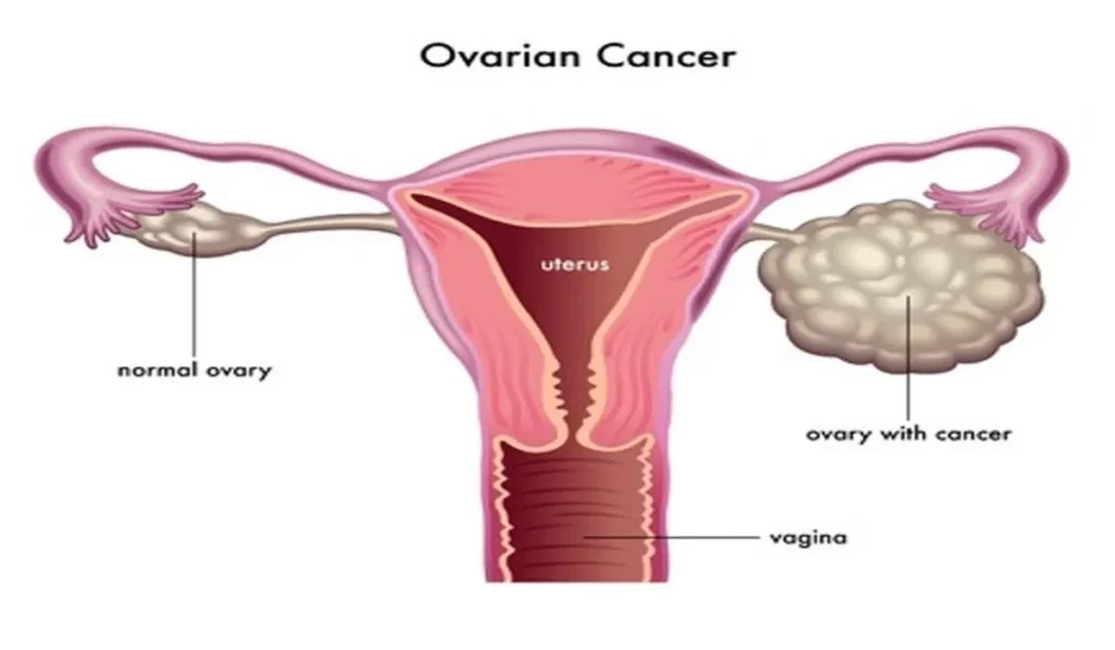 pr&eacute;vention cancer des ovaires