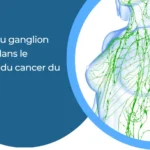 Chirurgie du ganglion sentinelle